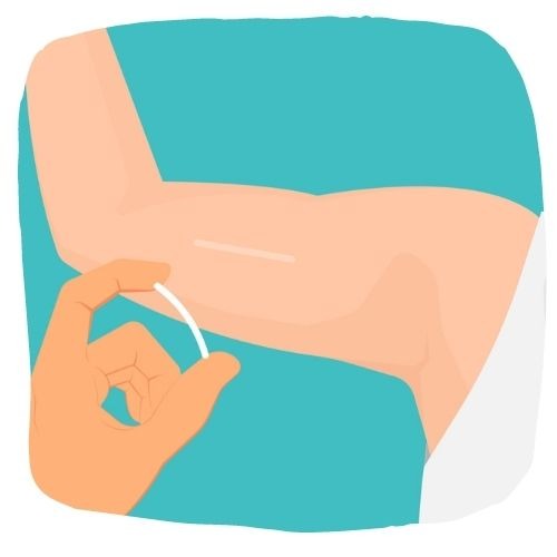 A contraceptive implant in the upper arm