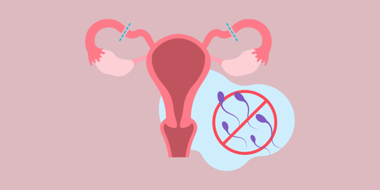 Tubal ligation