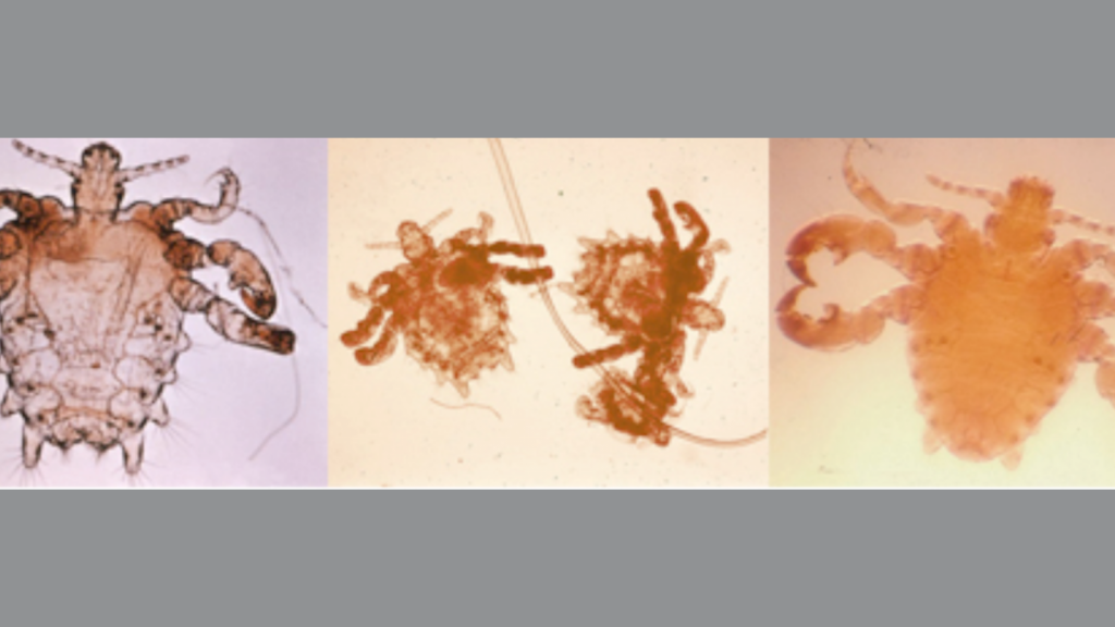 Pubic lice or crabs