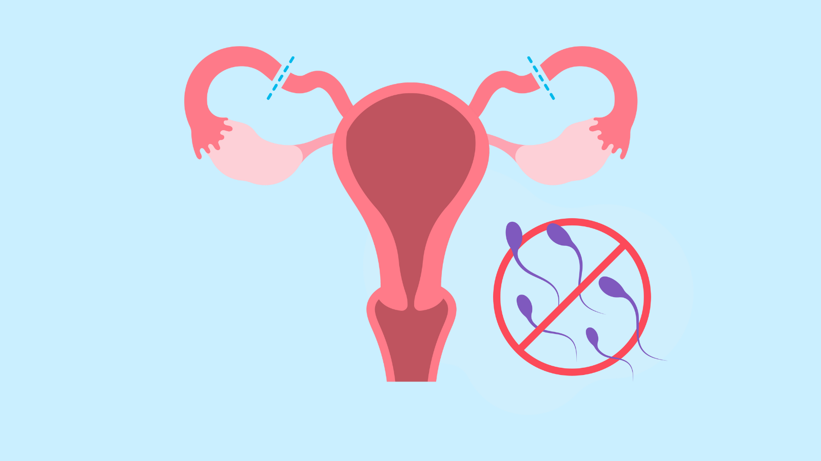 Tubal ligation(1)