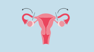 Removing fallopian tubes
